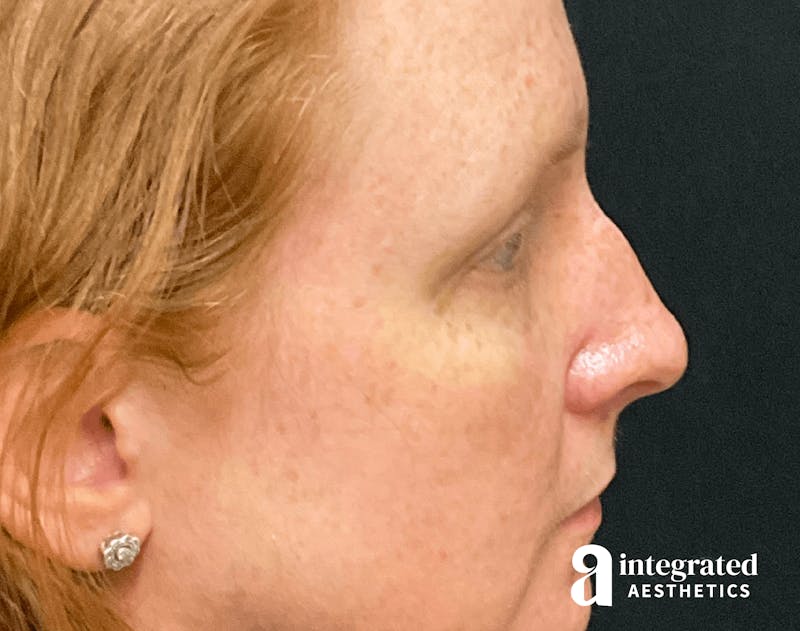 Rhinoplasty Before & After Gallery - Patient 133213248 - Image 1