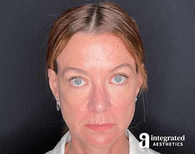 Sculptra Before & After Gallery - Patient 133213289 - Image 1