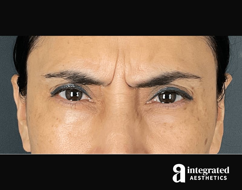 Wrinkle Relaxers Before & After Gallery - Patient 133213311 - Image 1