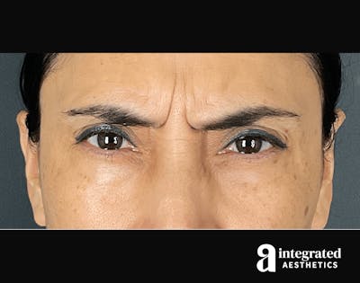 Wrinkle Relaxers Before & After Gallery - Patient 133213311 - Image 1