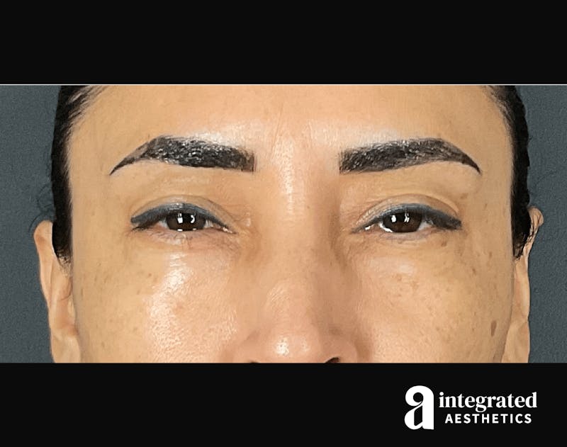 Wrinkle Relaxers Before & After Gallery - Patient 133213311 - Image 2