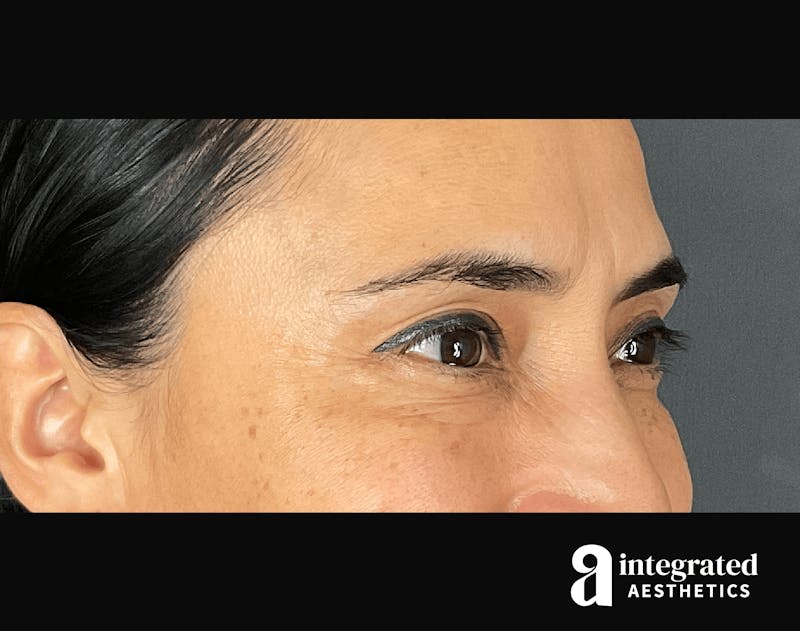 BOTOX PATIENT 133213311 Before Right Angle