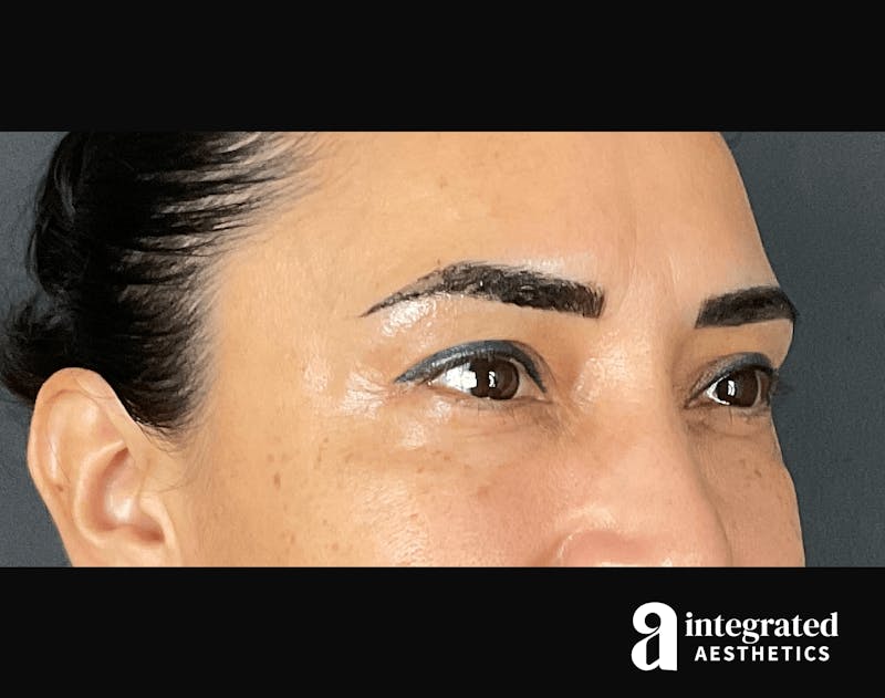 Wrinkle Relaxers Before & After Gallery - Patient 133213311 - Image 4