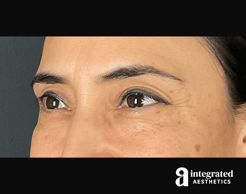Wrinkle Relaxers Before & After Gallery - Patient 133213311 - Image 5