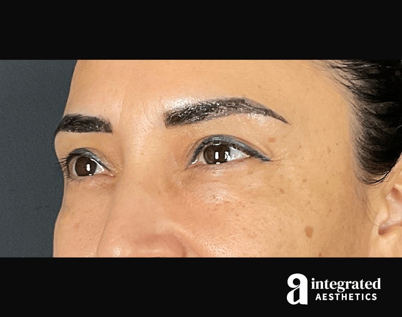 BOTOX PATIENT 133213311 After Left Angle