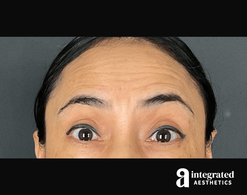 Wrinkle Relaxers Before & After Gallery - Patient 133213311 - Image 7