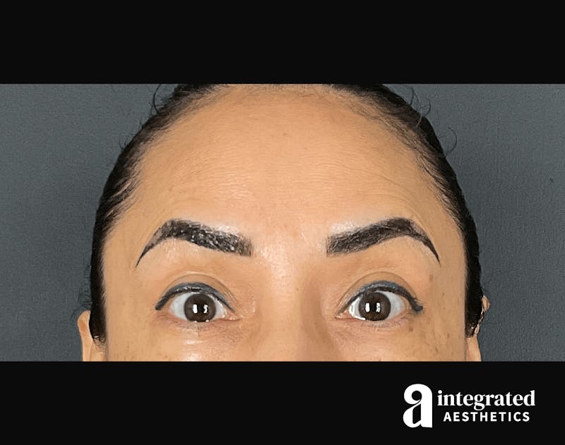 BOTOX PATIENT 133213311 After Forehead