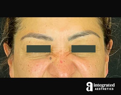 Wrinkle Relaxers Before & After Gallery - Patient 133213316 - Image 1