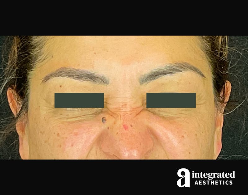 Wrinkle Relaxers Before & After Gallery - Patient 133213316 - Image 1