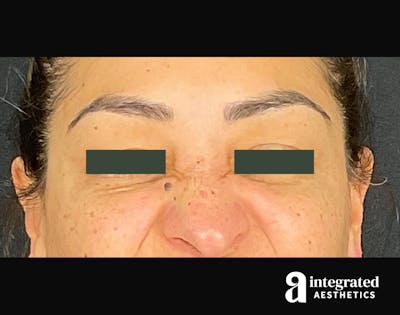 Wrinkle Relaxers Before & After Gallery - Patient 133213316 - Image 2