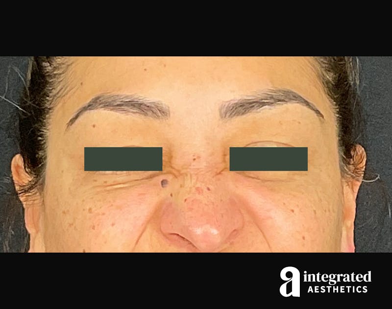 Wrinkle Relaxers Before & After Gallery - Patient 133213316 - Image 2
