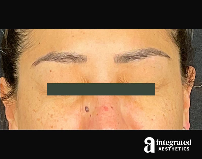 Wrinkle Relaxers Before & After Gallery - Patient 133213316 - Image 4