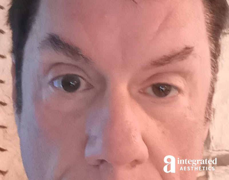 Resolved Aesthetic Complications Before & After Gallery - Patient 139510865 - Image 2