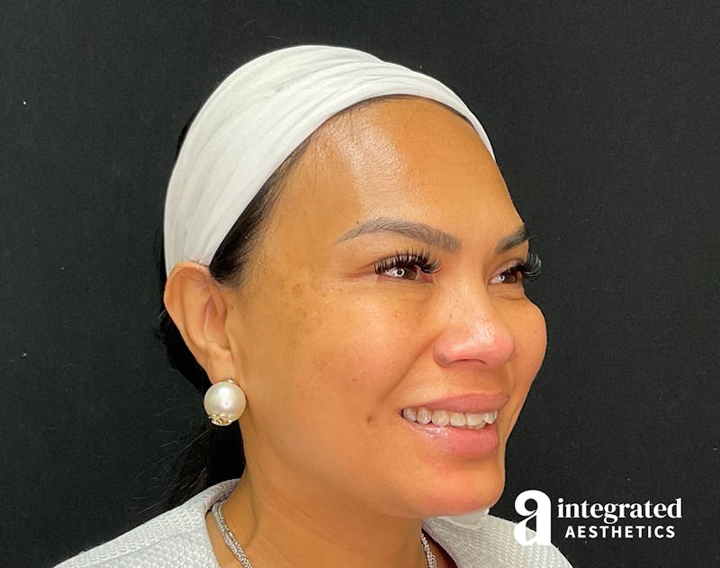 Wrinkle Relaxers Before & After Gallery - Patient 133213317 - Image 8