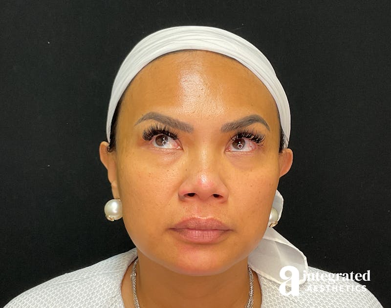 Wrinkle Relaxers Before & After Gallery - Patient 133213317 - Image 2