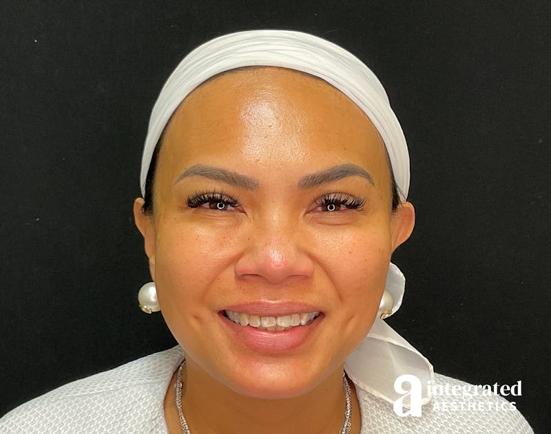Wrinkle Relaxers Before & After Gallery - Patient 133213317 - Image 4