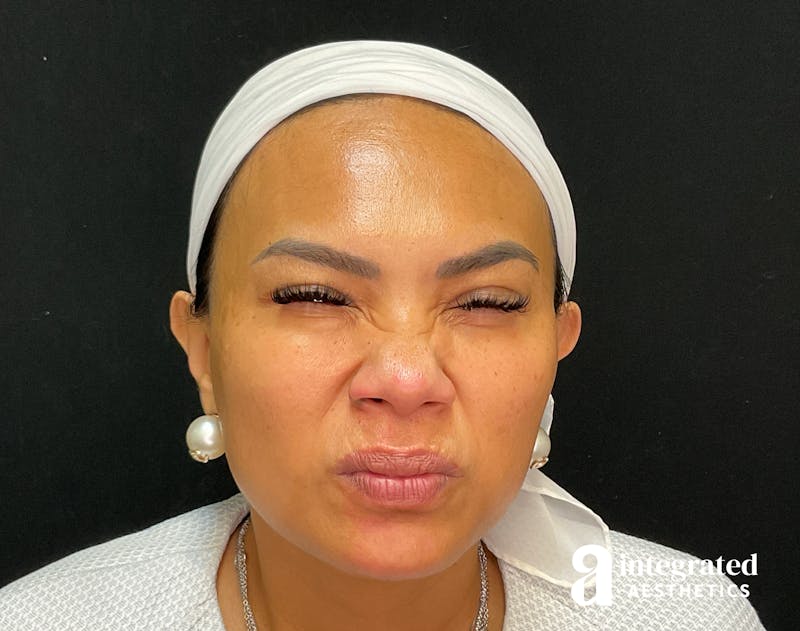 Wrinkle Relaxers Before & After Gallery - Patient 133213317 - Image 6