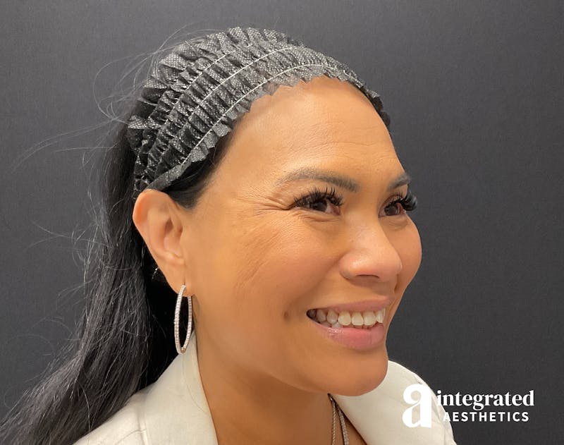 Wrinkle Relaxers Before & After Gallery - Patient 133213317 - Image 7