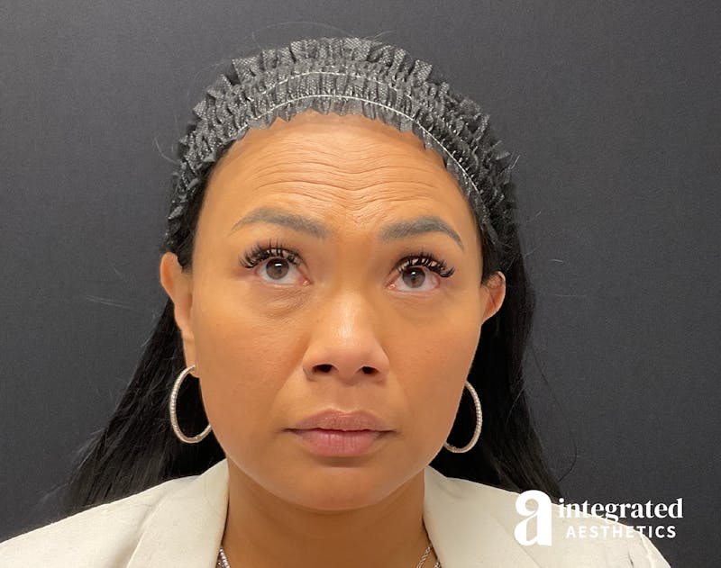 Wrinkle Relaxers Before & After Gallery - Patient 133213317 - Image 1