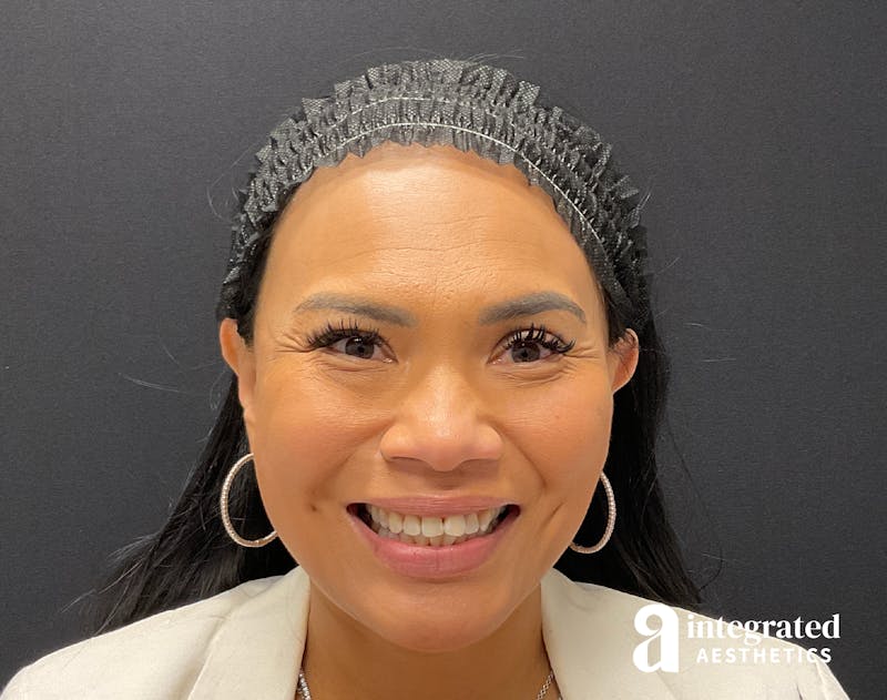 Wrinkle Relaxers Before & After Gallery - Patient 133213317 - Image 3