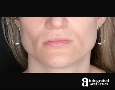 Wrinkle Relaxers Before & After Gallery - Patient 133213338 - Image 1