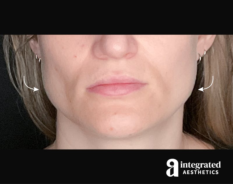 Wrinkle Relaxers Before & After Gallery - Patient 133213338 - Image 1