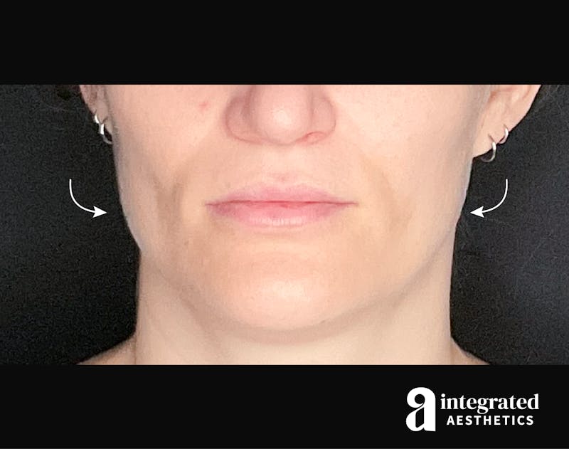 Wrinkle Relaxers Before & After Gallery - Patient 133213338 - Image 2
