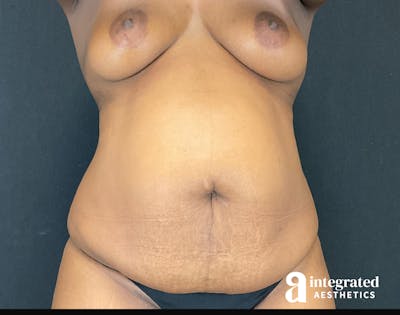 BodyTite Before & After Gallery - Patient 157175686 - Image 1