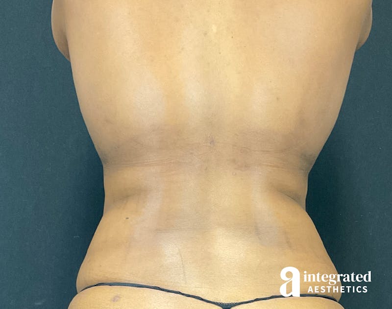 Tummy Tuck Before & After Gallery - Patient 133213384 - Image 7