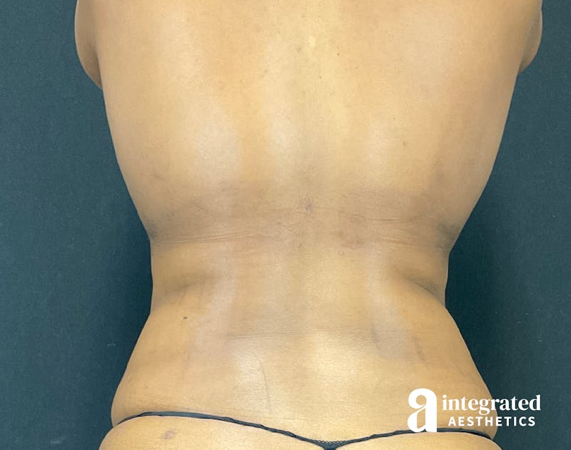 Tummy Tuck Before & After Gallery - Patient 133213384 - Image 7