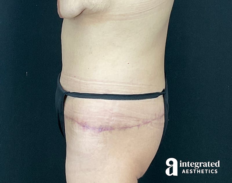 Tummy Tuck Before & After Gallery - Patient 133213392 - Image 8