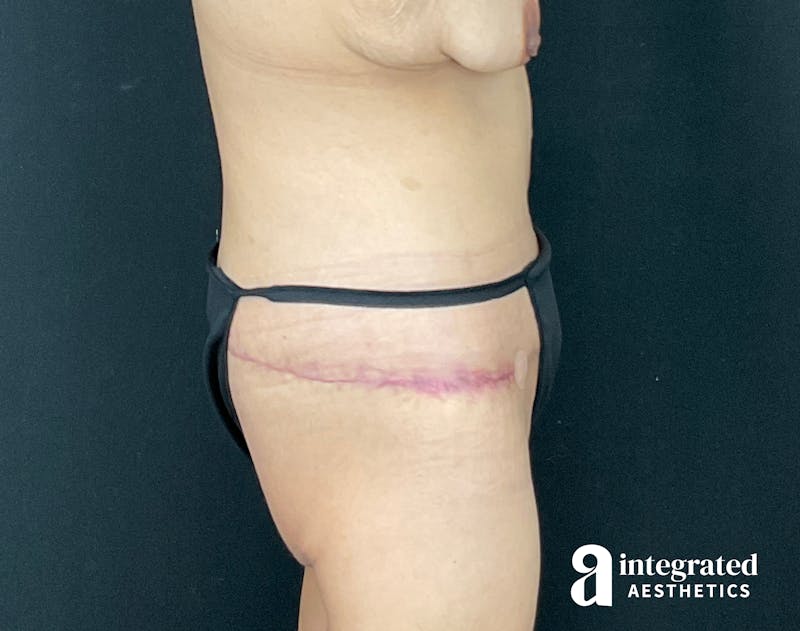 Tummy Tuck Before & After Gallery - Patient 133213392 - Image 10