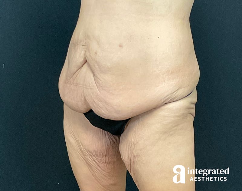 Tummy Tuck Before & After Gallery - Patient 133213392 - Image 5