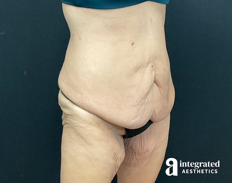 Tummy Tuck Before & After Gallery - Patient 133213392 - Image 3