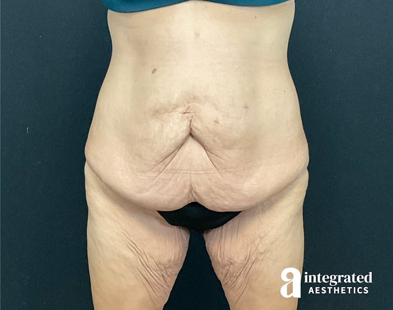 Tummy Tuck Before & After Gallery - Patient 133213392 - Image 1