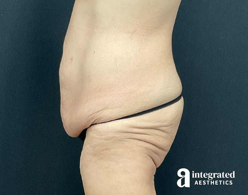 Tummy Tuck Before & After Gallery - Patient 133213392 - Image 7