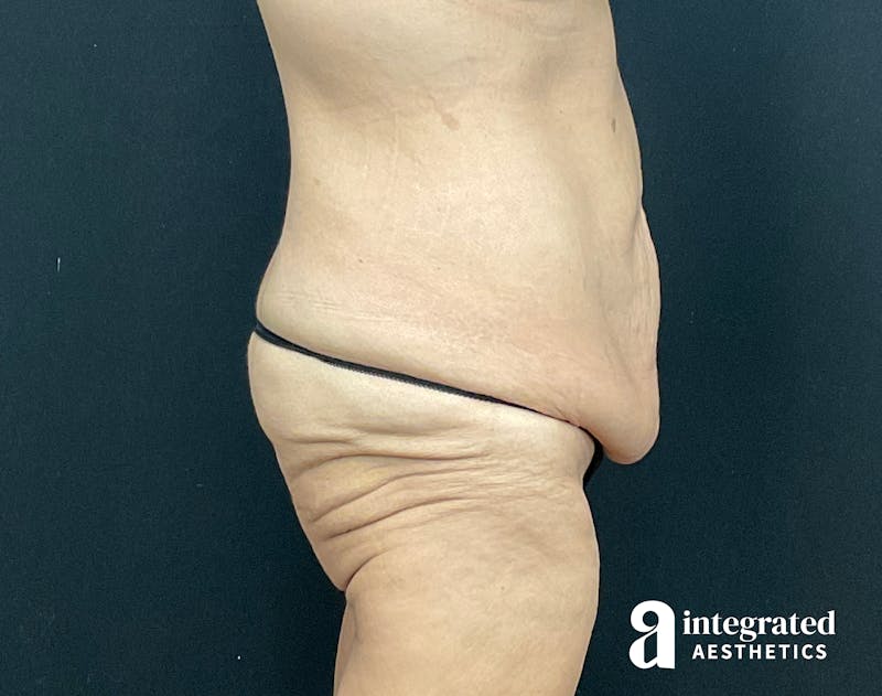 Tummy Tuck Before & After Gallery - Patient 133213392 - Image 9