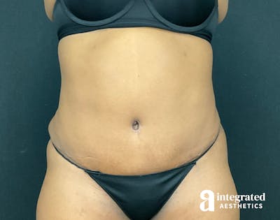 Tummy Tuck Before & After Gallery - Patient 133213462 - Image 2