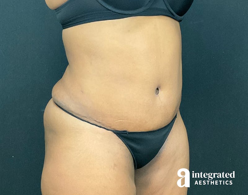 Tummy Tuck Before & After Gallery - Patient 133213462 - Image 4
