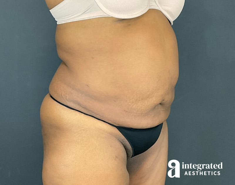 Tummy Tuck Before & After Gallery - Patient 133213462 - Image 3