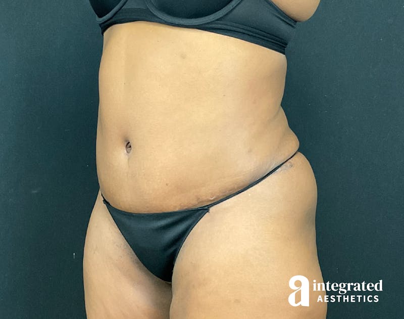 Tummy Tuck Before & After Gallery - Patient 133213462 - Image 6