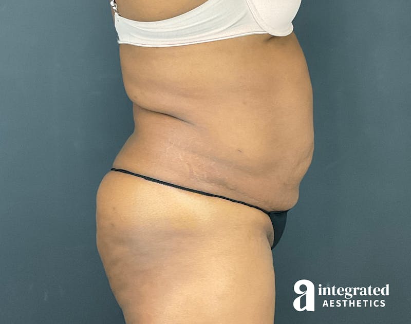 Tummy Tuck Before & After Gallery - Patient 133213462 - Image 7