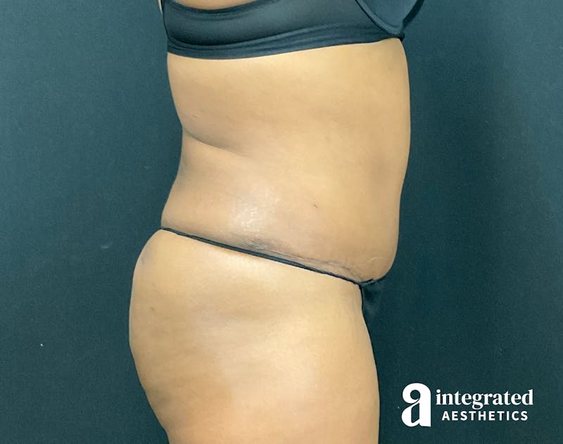 Tummy Tuck Before & After Gallery - Patient 133213462 - Image 8