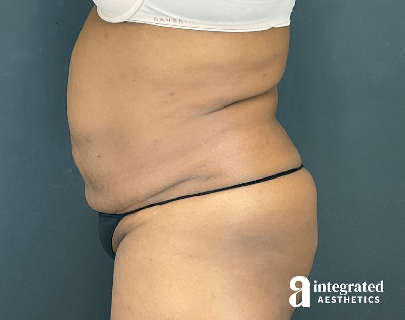 Tummy Tuck Before & After Gallery - Patient 133213462 - Image 9