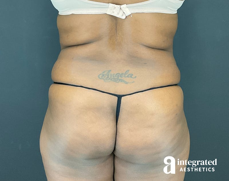 Tummy Tuck Before & After Gallery - Patient 133213462 - Image 11