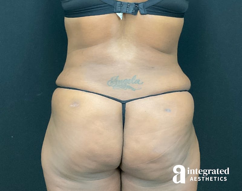 Tummy Tuck Before & After Gallery - Patient 133213462 - Image 12