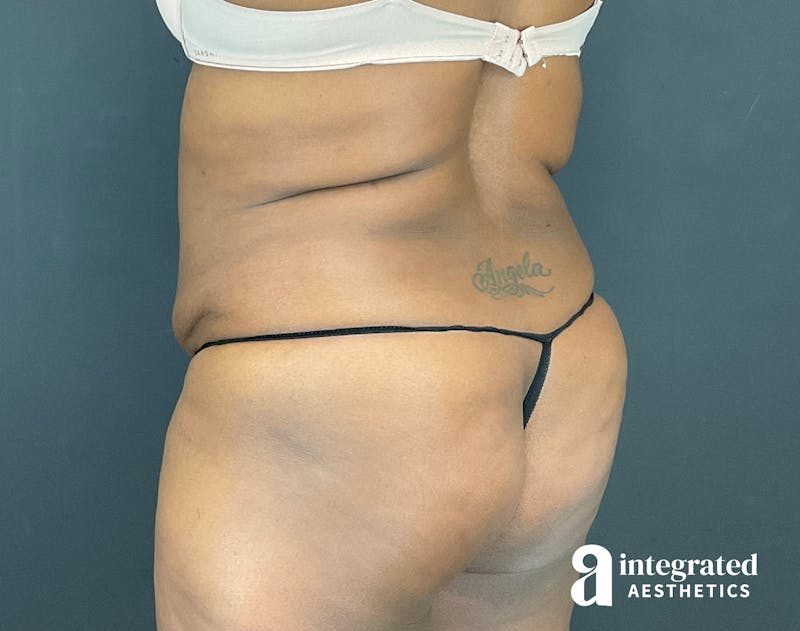 Tummy Tuck Before & After Gallery - Patient 133213462 - Image 15
