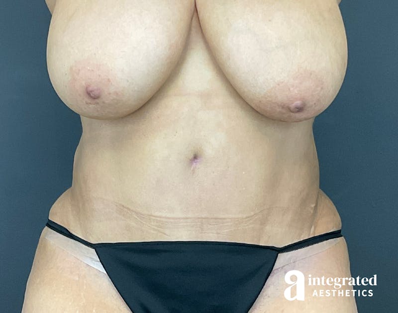 Tummy Tuck Before & After Gallery - Patient 133213465 - Image 2