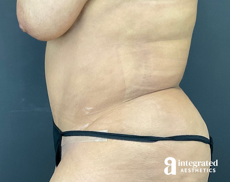 Tummy Tuck Before & After Gallery - Patient 133213465 - Image 8