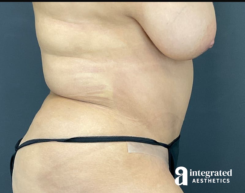 Tummy Tuck Before & After Gallery - Patient 133213465 - Image 10